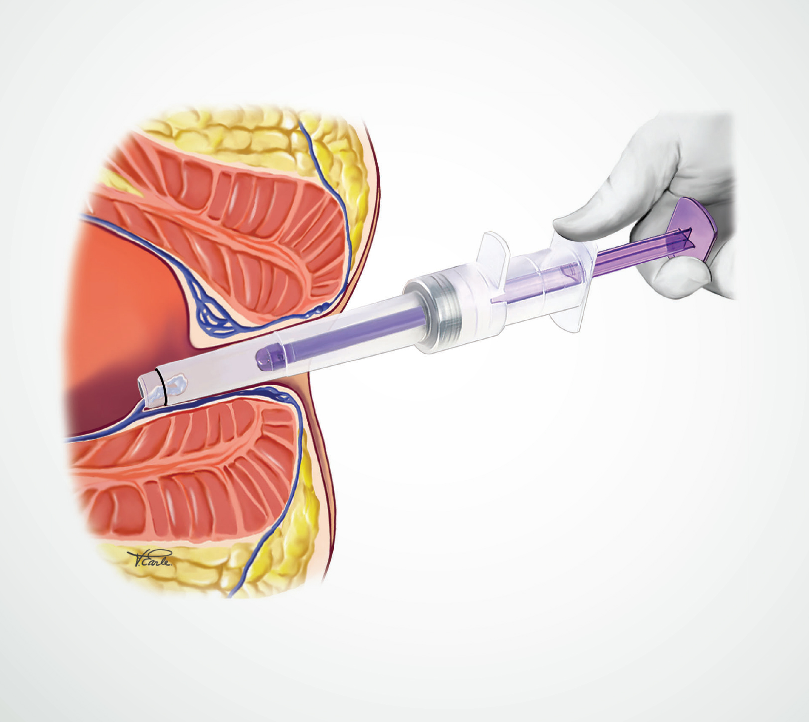 CRH O'Regan System: NonSurgical Hemorrhoid Banding Treatment